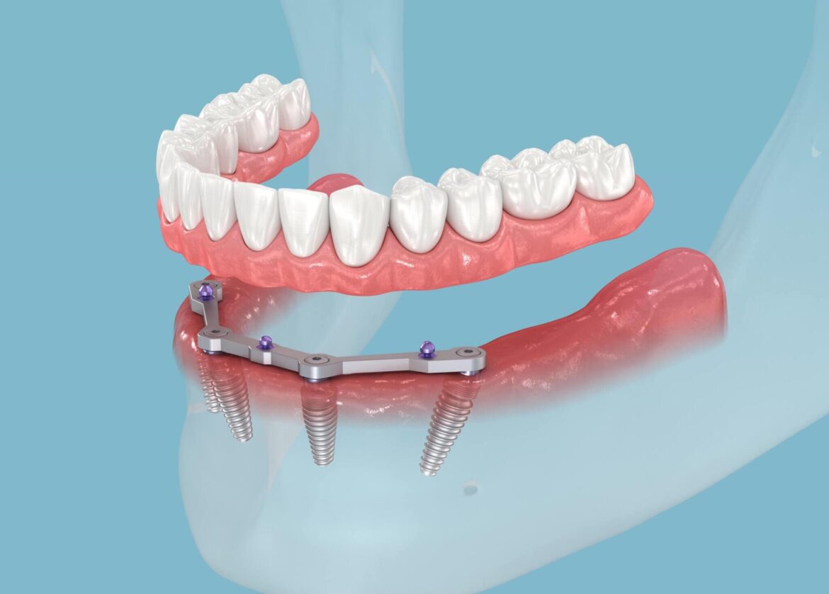 Breaking Barriers: The Science of Bone Integration in Dental Implants