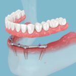 Breaking Barriers: The Science of Bone Integration in Dental Implants