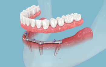 Breaking Barriers: The Science of Bone Integration in Dental Implants