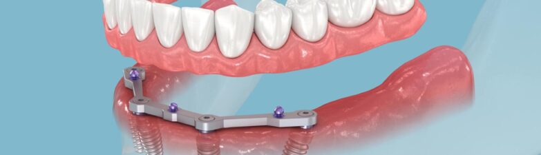 Breaking Barriers: The Science of Bone Integration in Dental Implants
