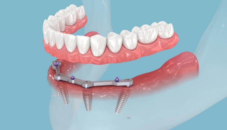 Breaking Barriers: The Science of Bone Integration in Dental Implants